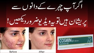 How to Treat Acne Scars Marks? This Acne Cream Remove Pimples 100% - Mahnoor Beauty Tips