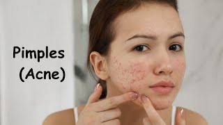 Pimples (Acne) and its types, Why do we get Pimples