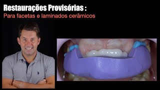 Restaurações provisórias para  Facetas / Laminados cerâmicos.