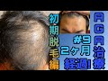 AGA治療2か月経過！2ヶ月と言うのは正念場と言える期間でした…