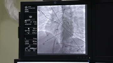 Successful ablation of Concealed left lateral accessory Pathway by trans septal approach