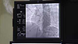 Successful ablation of Concealed left lateral accessory Pathway by trans septal approach