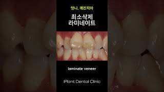 보철과 전문의 라미네이트 (feat. 최소삭제)