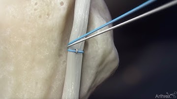 Knotless FiberTak® Biceps Implant System for Proximal Biceps Tenodesis