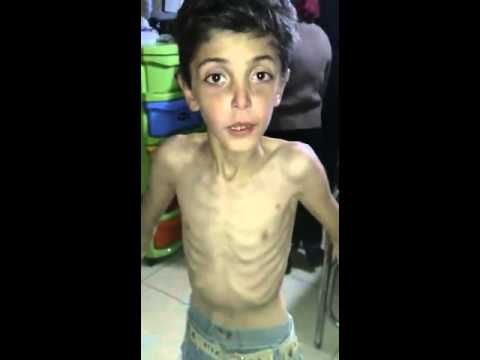 طفل سوري لم ياكل منذ 7 أيام في مضايا