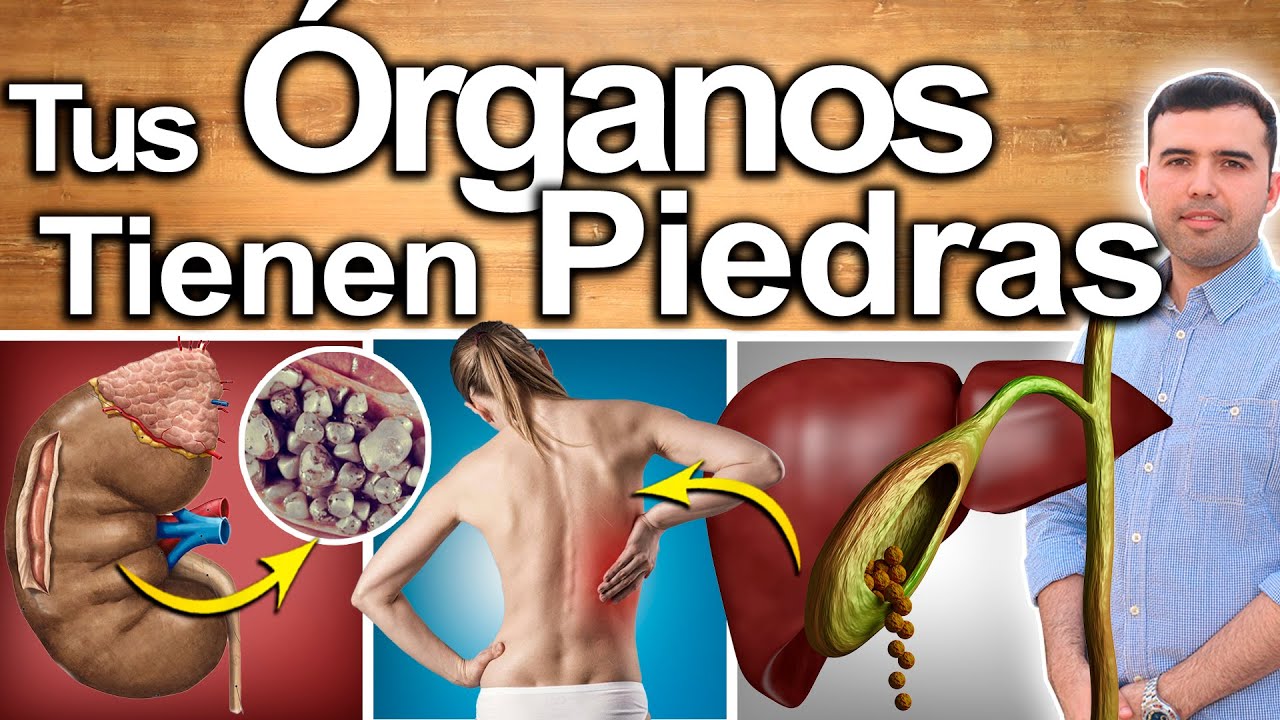 ASÍ ELIMINÉ LAS PIEDRAS EN LOS RIÑONES Y CÁLCULOS EN LA VESÍCULA ...