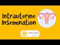 Intrauterine insemination  the hive fertility clinic  chennai