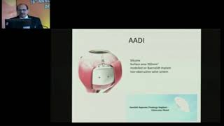 AIOC2018 - IC372 - Topic - Glaucoma Drainage Devices :  what is available? - Dr. PARUL GOYAL