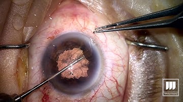 How to Tie a McAhmed Knot for Iris Cerclage