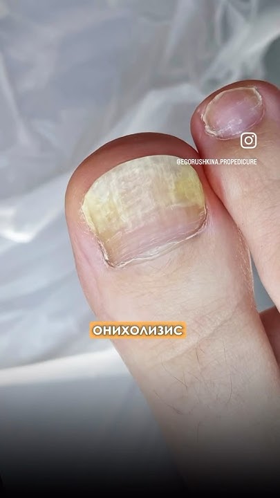 только в одном случае можно покрыть #ногти гель-лаком #подолог #nails # ...