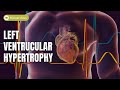 Masterclass on left ventricular hypertrophy lvh and ecg criteria clinical essentials