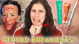 How To Get Rid Of Period Breakouts & What I Use For Last Min Zits and Pimples