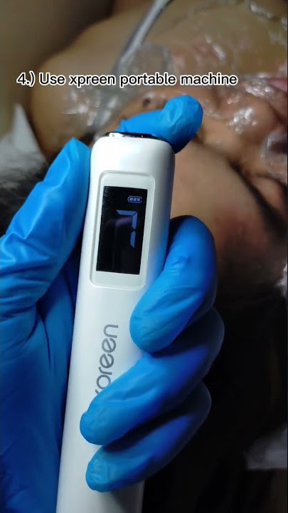 Download lagu Wart removal using xpreen machine😱#shorts