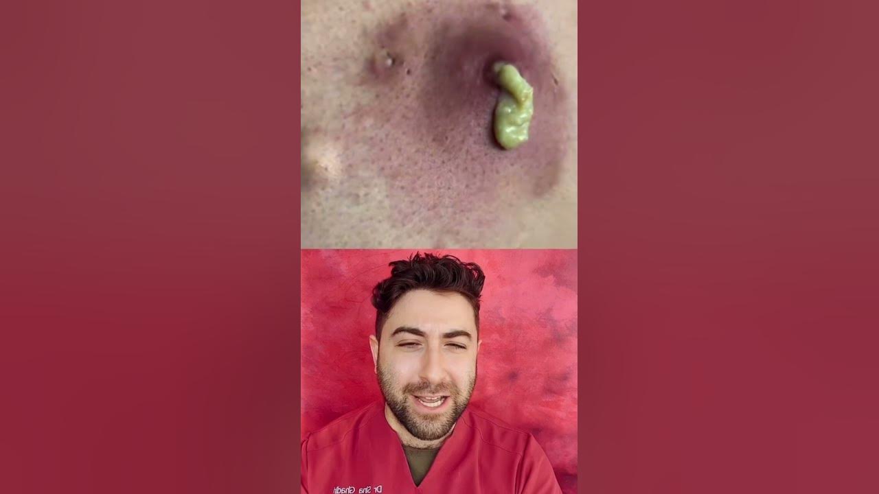 can-you-tell-if-a-pimple-is-infected-based-on-colour-youtube