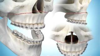 Maxillary Advancement Surgery