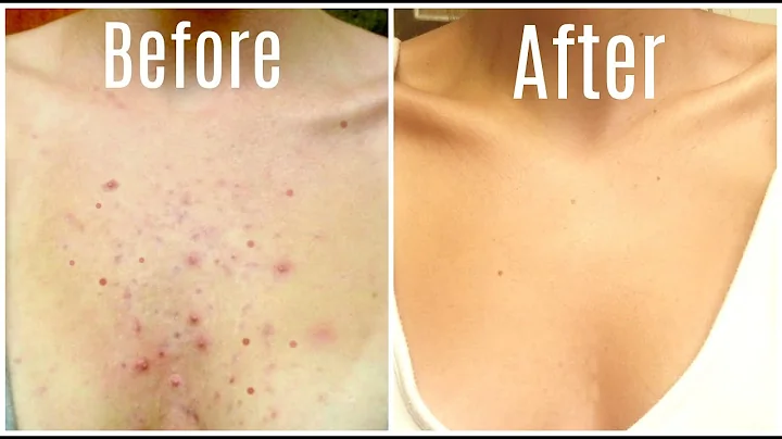 How I Got Rid Of My Body Acne FOREVER! - DayDayNews