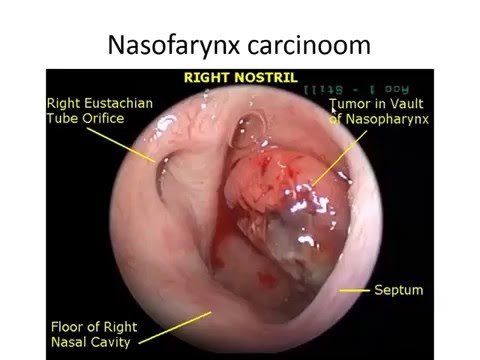 nasofarynxcarcinoom