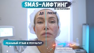 Smas-лифтинг на ULTRAFORMER | Реальный результат и отзыв о процедуре