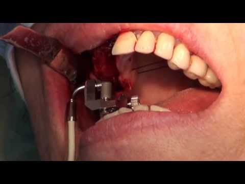 iraise-sinus-lift-procedure,-dr-better-h,-tlv,-israel-aug-2012