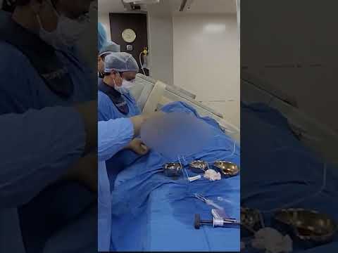 #SHORTS#CAROTID STENTING IN 15 MINUTES#IR FACILITIES TREATMENT