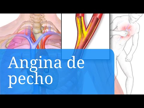 Video: Cómo reconocer los dolores de angina (con imágenes)