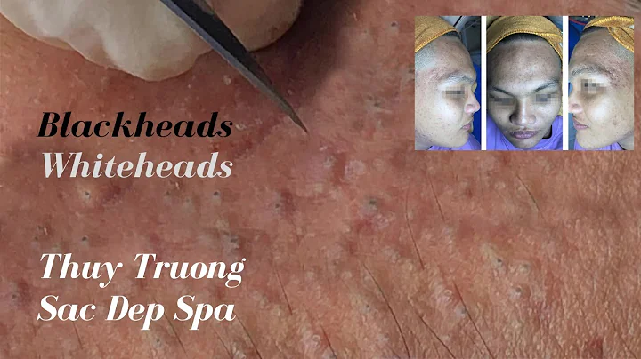 Thuy Truong removes her customers' blackheads and ...