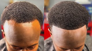 The 20+ How To Fix A Receding Hairline 2022: Must Read