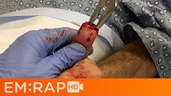 Bone Rongeur for Fingertip Amputations