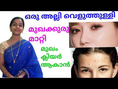 മുഖക്കുരു-മാറ്റി-മുഖം-ക്ലിയർ-ആകാൻ-ഒരു-അല്ലി-വെളുത്തുള്ളി-മതി|home-remedies-for-pimple-and-black-mark