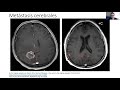 Webinar: Casos clínicos - Neurología