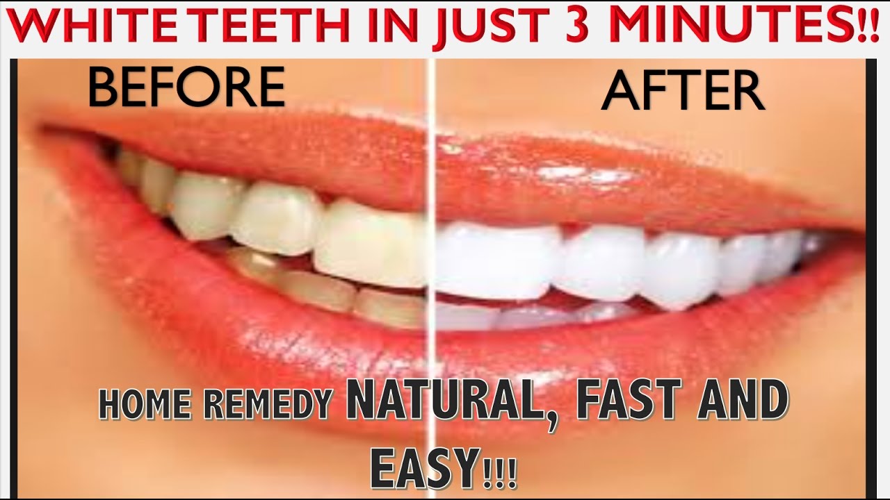 White Teeth In Just 3 Minutes At Home! Naturally And Fast