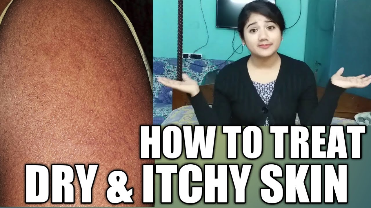 HOW TO TREAT DRY & ITCHY SKIN YouTube