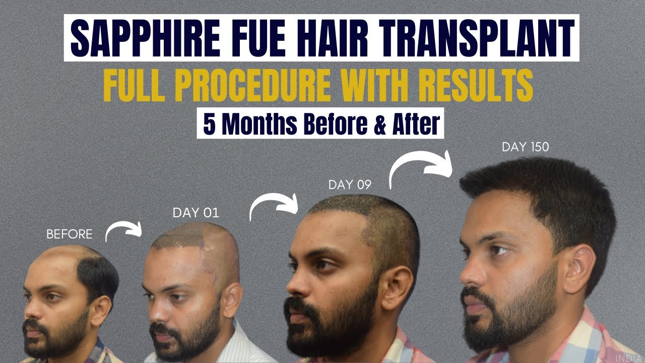 Best Hair Transplant Results With Sapphire FUE In India Before And 
