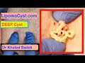 Dr Khaled Sadek. 3year Back Cyst. LipomaCyst.com