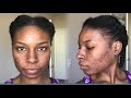 My Journey To Clear Skin  - Vlog #2