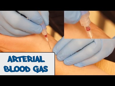 Arterial Blood Gas Sampling (ABG) - OSCE Guide (old version) | UKMLA | CPSA