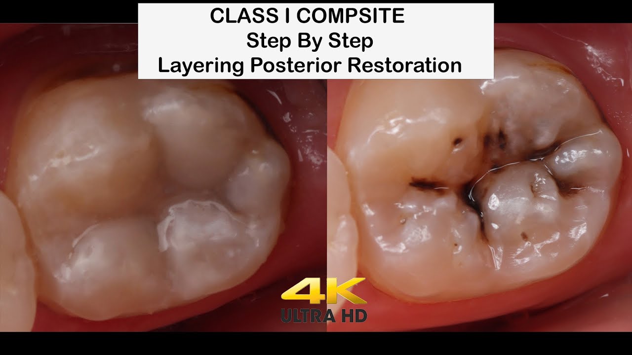 Step by Step Class I Dental Filling Procedure Dental Clinic