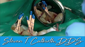 Endodontics on Adjacent Mandibular Molars - Dental Minute with Steven T. Cutbirth, DDS