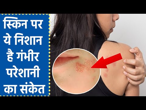 Skin पर चकत्ते, पित्ती या रैशेज से हो सकती है गंभीर परेशानी । ऐसे पहचानें लक्षण । Boldsky