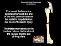 Femoral Shaft Fracture in Children - Everything You Need To Know - Dr. Nabil Ebraheim