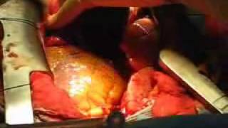 Видео Бьющееся человеческое сердце (автор: MedicalTelevisions)