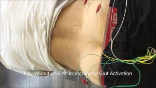 Neurofunctional Acupuncture in Ottawa