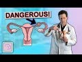 Tubal Pregnancy - This video could save your fertility & your life!!
