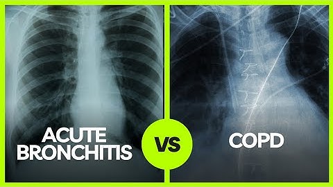 Understanding the Differences: Acute Bronchitis vs COPD | Medical Insights