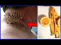 Banana peels in 1 night remove skin tags yourself safely / best way to remove skin tags in 1 night