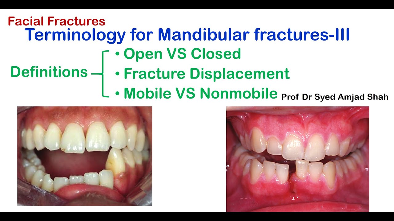 Definition Open Vs Closed Fractures Mandibular Fractures Syed Amjad My XXX Hot Girl