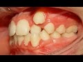 Orthodontic Treatment of Ectopic Upper Canine - No Extraction (Salah 12yrs)