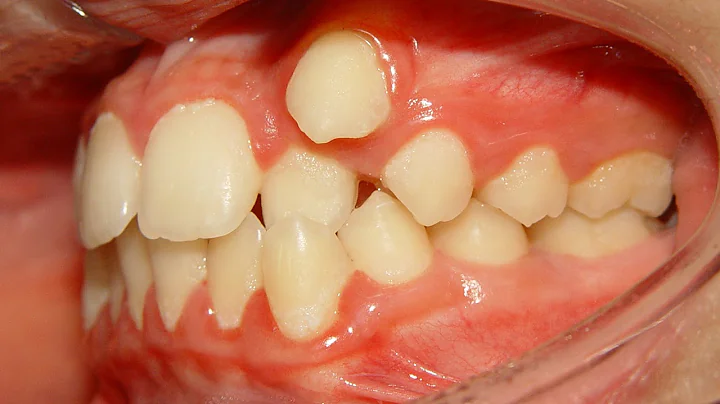 Orthodontic Treatment of Ectopic Upper Canine - No Extraction (Salah 12yrs) - DayDayNews