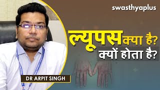 ल्यूपस - लक्षण, कारण और इलाज | Dr Arpit Singh on Lupus in Hindi | Symptoms & Treatment
