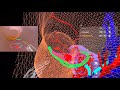 Vr esd simulation by holoeyes  metaquest endoscopic submucosal resection for early gastric cancer